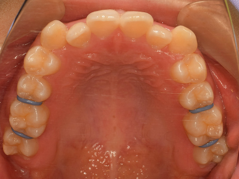 1、セパレーション