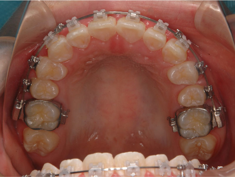2、バンドフォーミング