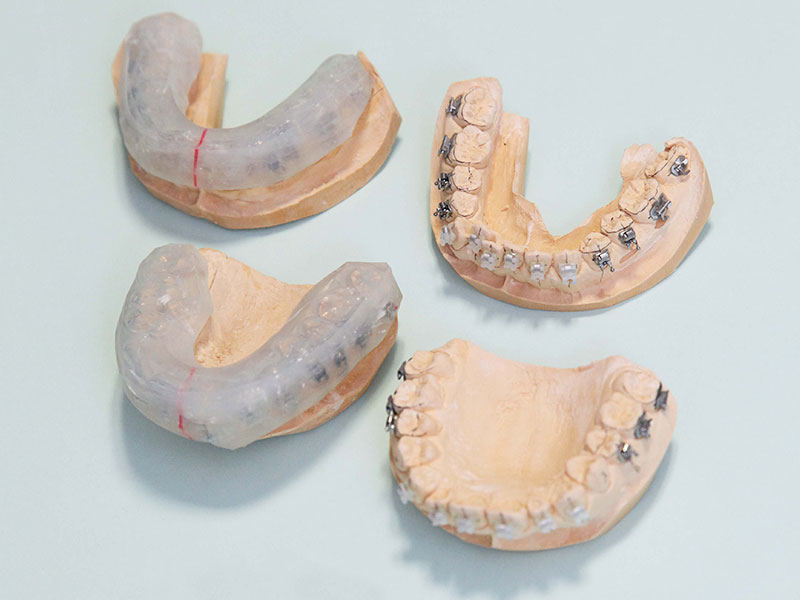 3、インダイレクトボンディング