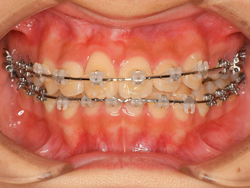 4、ワイヤーセット