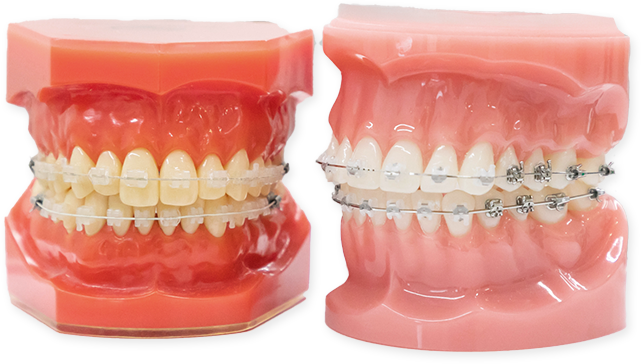 ブラケットワイヤー矯正