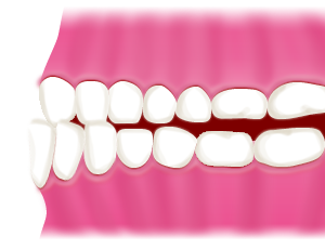 受け口【 下顎前突/かがくぜんとつ 】