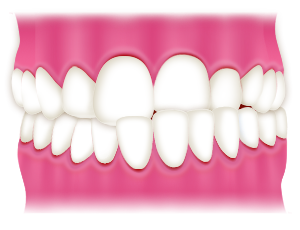 交叉咬合【 こうさこうごう/クロスバイト 】