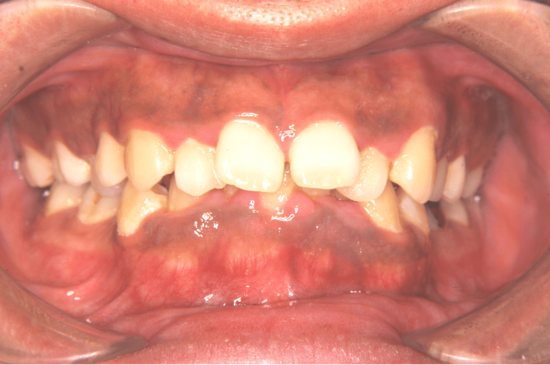 出っ歯（上顎前突）