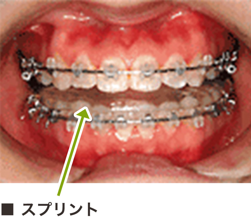 3.手術前スプリント装着